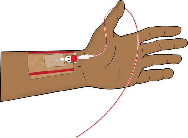 Learning to do Arterial Lines