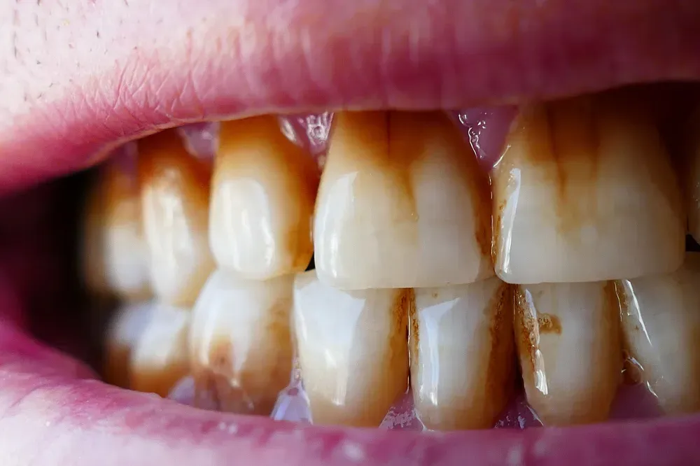 does coffee cause cavities