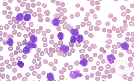Hematological Malignancies: Follicular Lymphoma