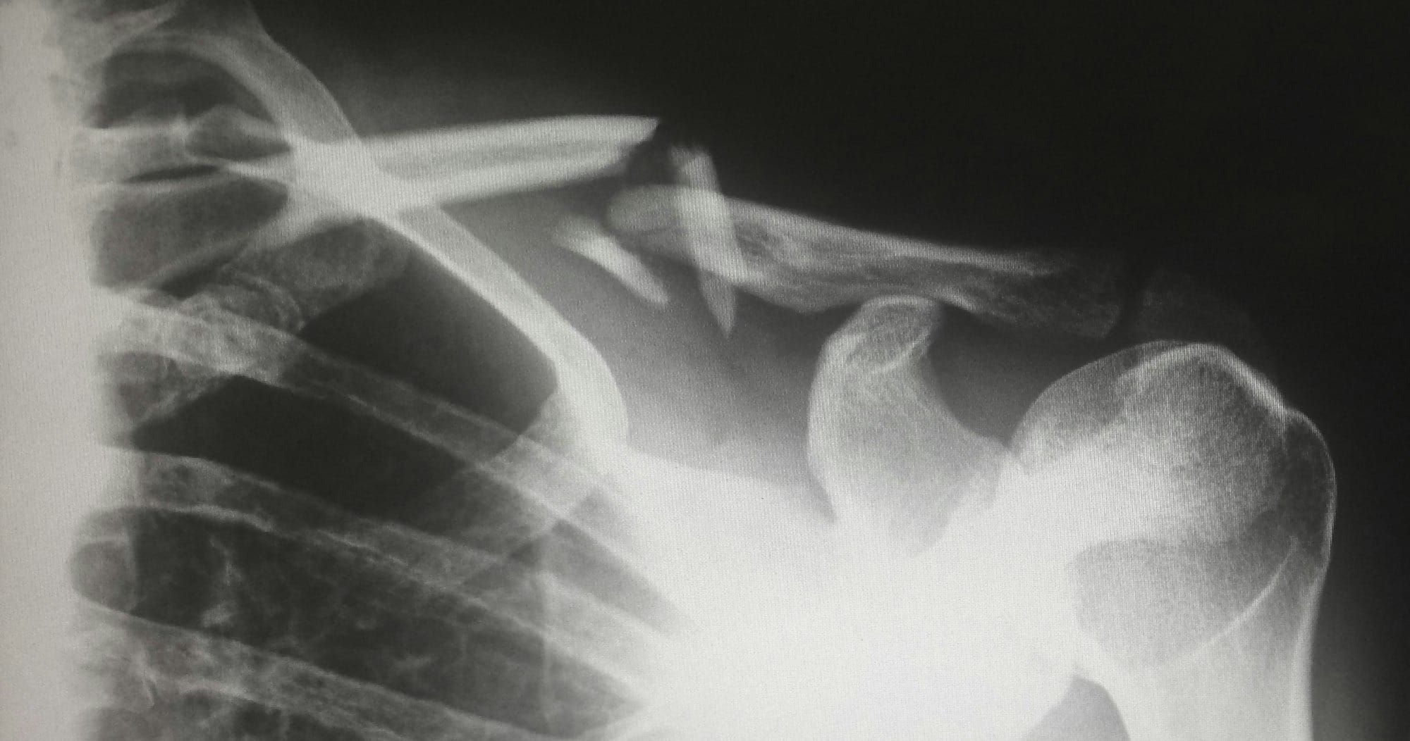 POvIV Trial Journal Club