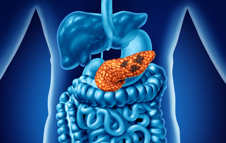 GI Malignancies: Pancreatic Cancer