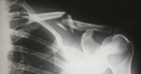 POvIV Trial Journal Club