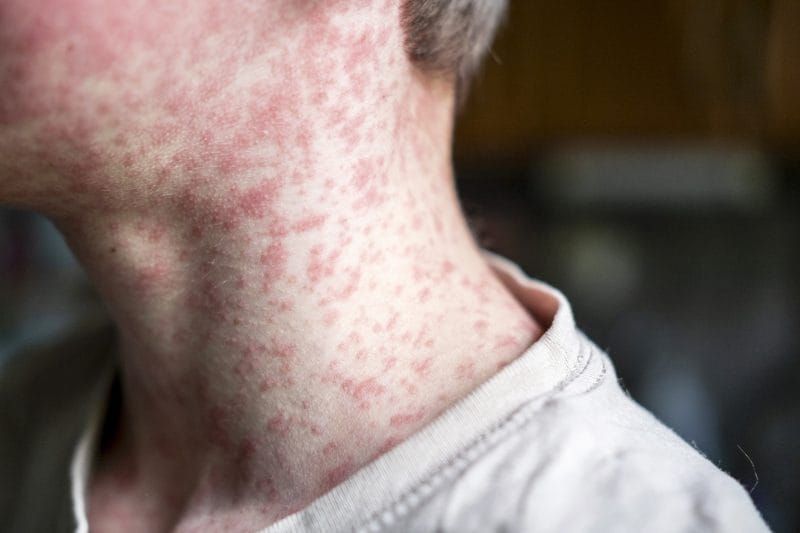 2,318 Measles Cases and Counting. The Outbreak Map Traces Directly to RFK Jr.'s Policy Footprint.