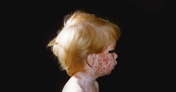 Measles and Whooping Cough Outbreaks Surge in States That Adopted RFK Jr.'s Vaccine Policies