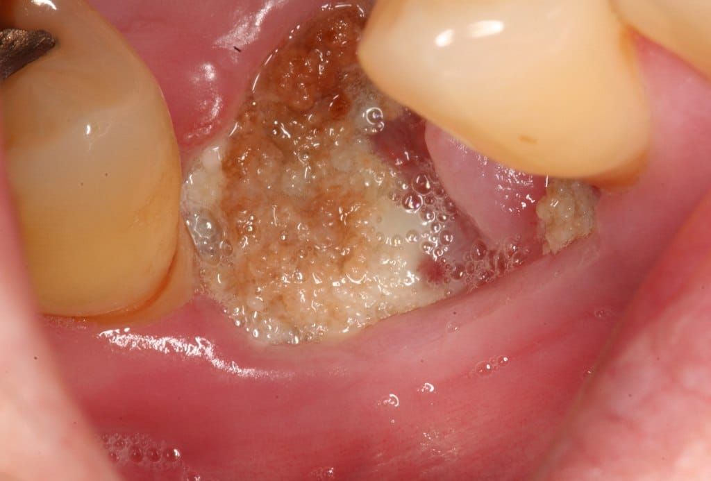Deep Dive: Updated Guidelines on Implant Placement and Medication-Related Osteonecrosis of the Jaw (MRONJ)