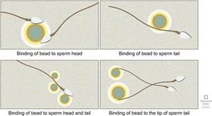 Antisperm Antibody Testing: A Comprehensive Review of Its Role in the  Management of Immunological Male Infertility and Results of a Global Survey  of Clinical Practices