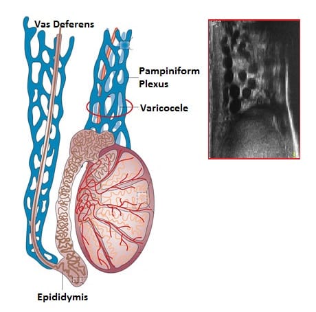 Varicocele – Sonographic Tendencies
