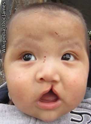 Society – Stem cell hope for cleft palate babies