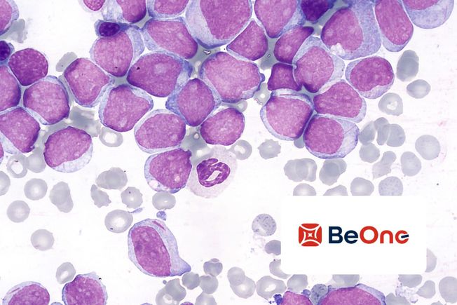 Blood cancer cells in a stained smear under a microscope