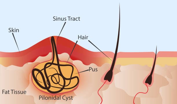 Kyste pilonidal