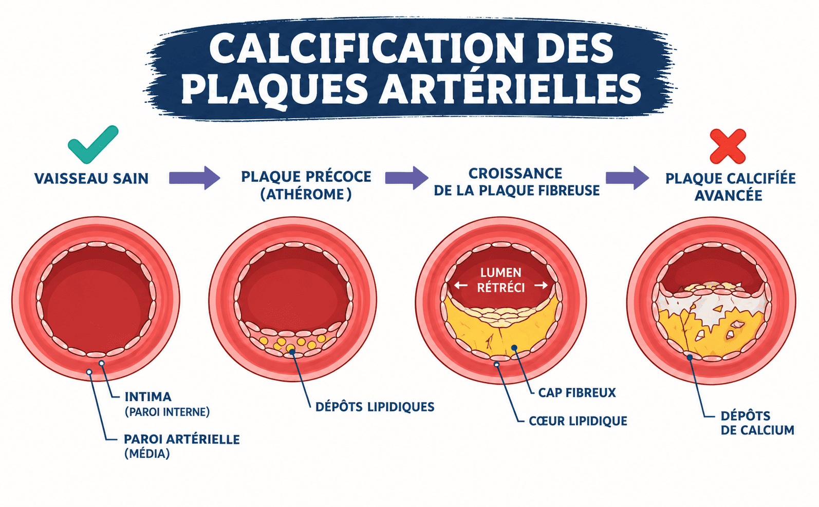 calcification coronarienne
