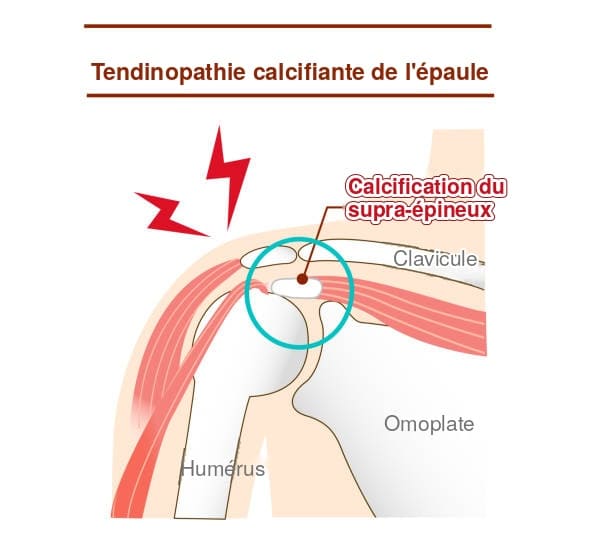 calcification du supra-épineux