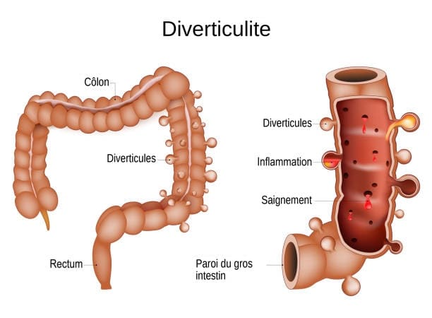 diverticulite