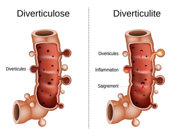diverticulose vs diverticulite