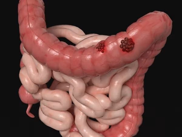 diverticulite