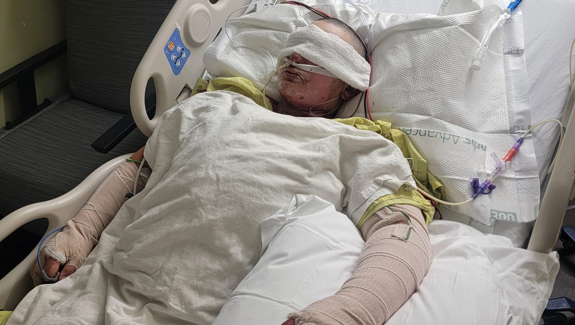 Matthew Garcia lies in a hospital bed with bandages and medical lines after sustaining burn injuries.