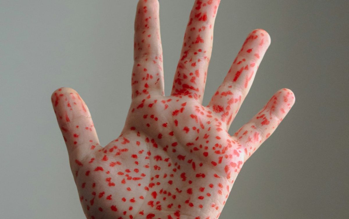 Measles cases rise to 54 in New Mexico, mostly in Lea County