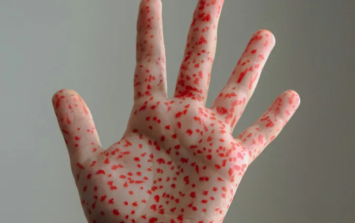 Measles cases rise to 54 in New Mexico, mostly in Lea County