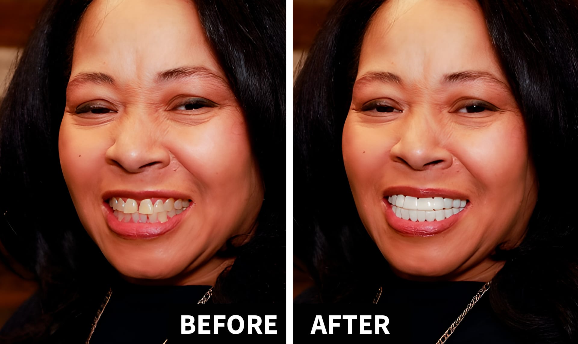 Shiny Smile Veneers before and after results woman