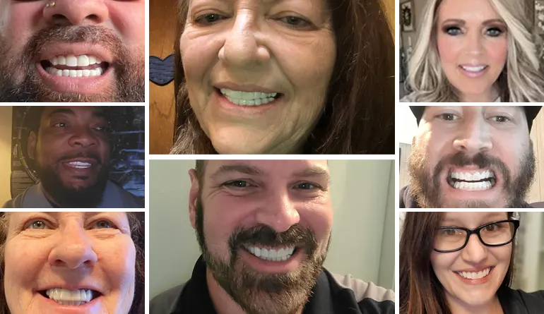 Shiny Smile Veneers before and after results many people