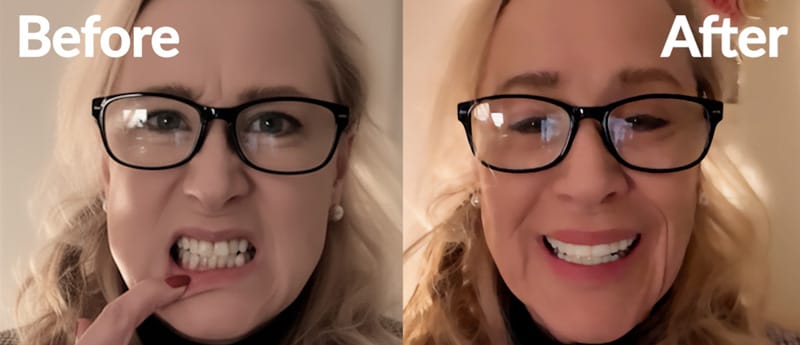 Before and after results wearing Shiny Smile custom snap-on veneers