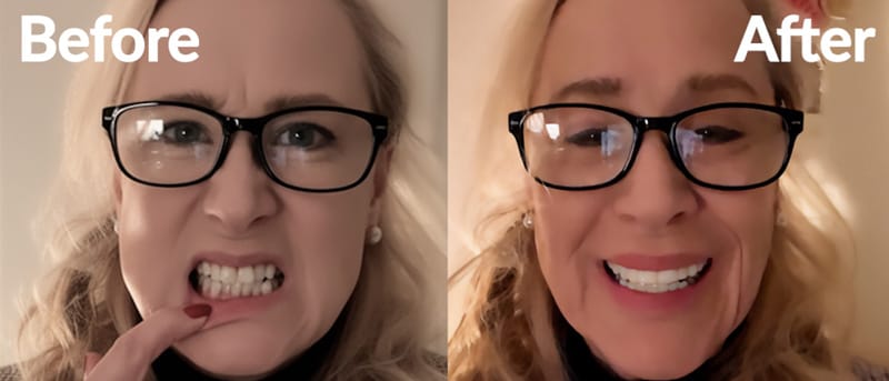 Before and after wearing Shiny Smile custom snap-on veneers