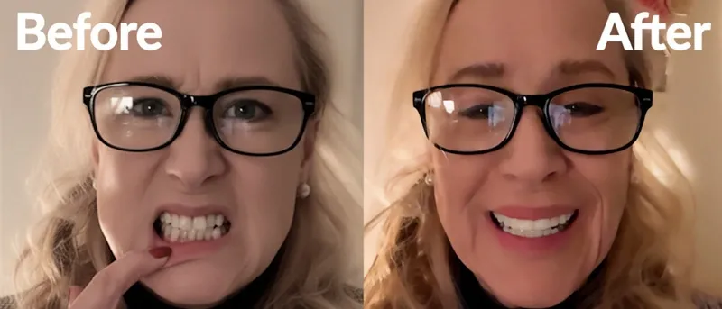 Smile Veneers before and after — natural smile transformation with custom snap-on veneers