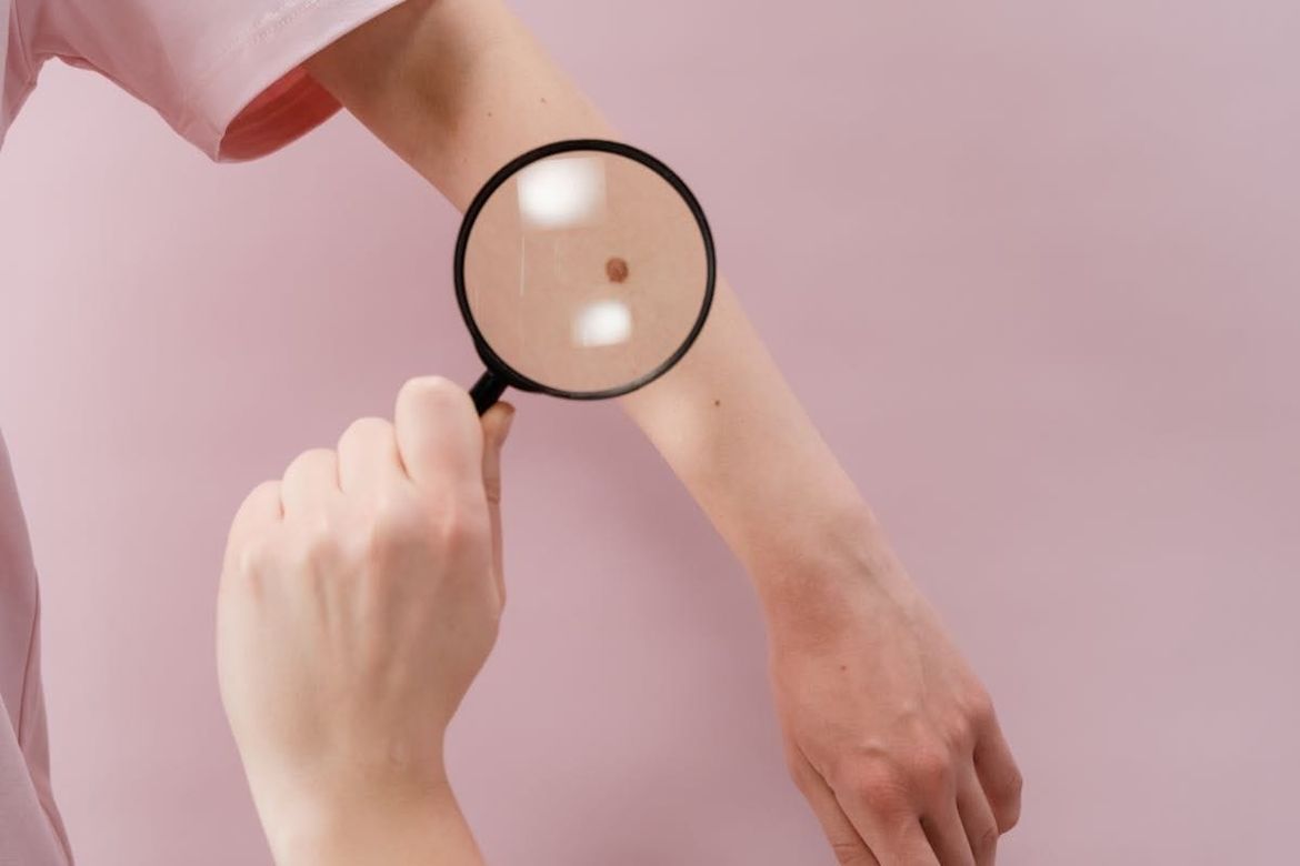 Bakar organizira preventivne preglede i edukacije o ranom otkrivanju melanoma