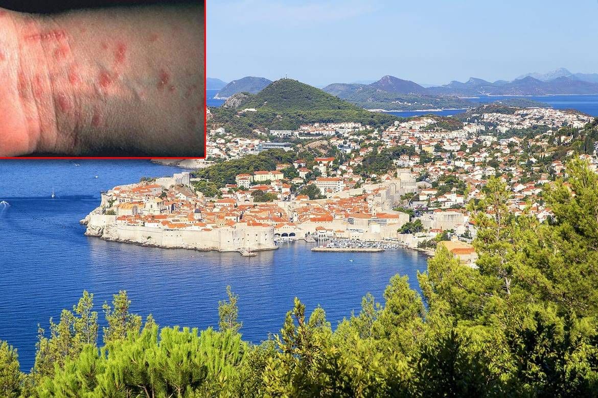 U Dubrovniku se pojavio svrab, ovo je potrebno znati!