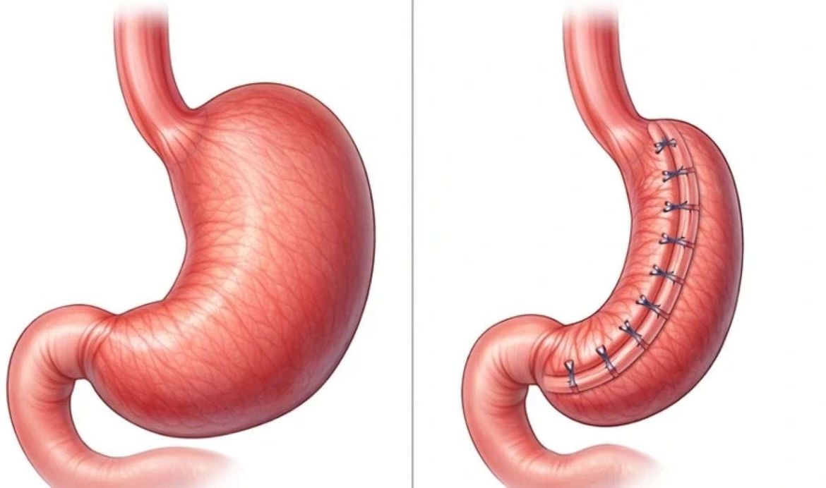 Svjetski dan debljine - KBC Rijeka prvi je u Hrvatskoj izveo zahvat endoskopskog smanjivanja želuca