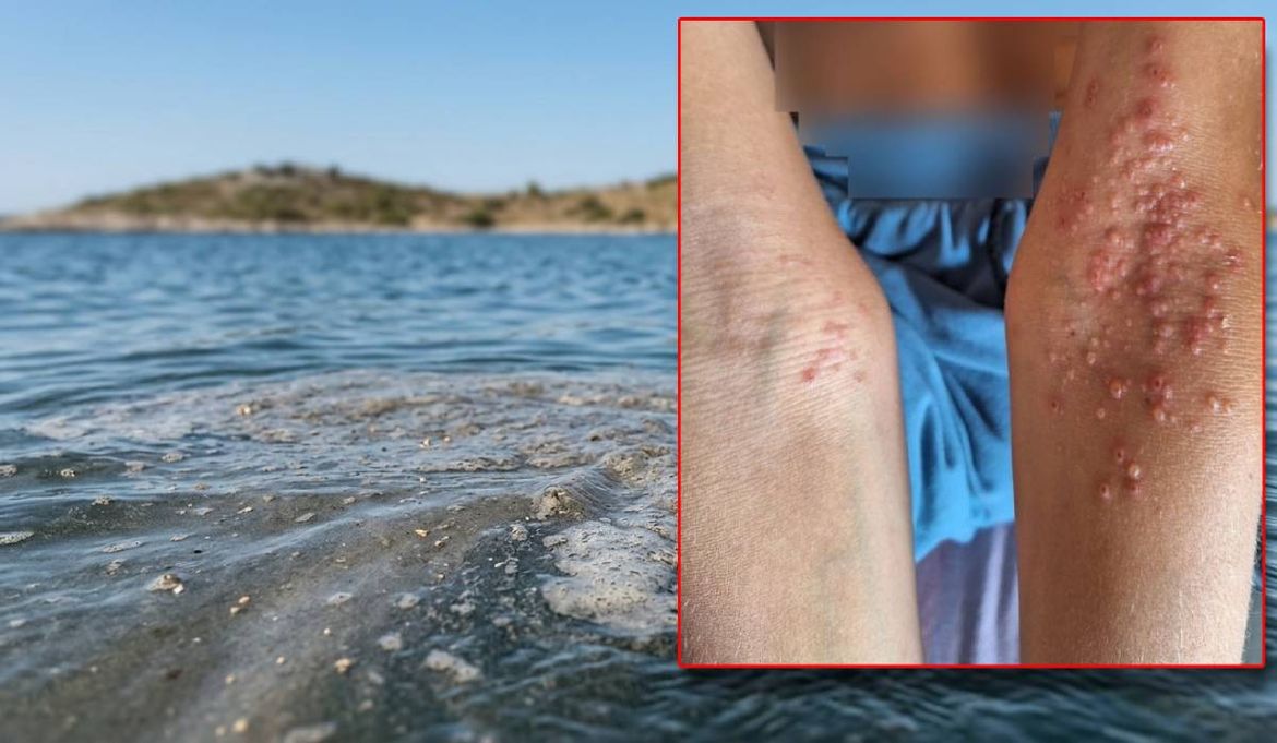 IMPETIGO Bolest gotovo iščezla kad se čovječanstvo počelo prati, sad hara jadranskom obalom - Zbog najglupljeg nemara, najugroženija su djeca!