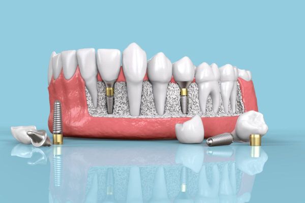 Understanding the Cost of Dental Implants in Dubai