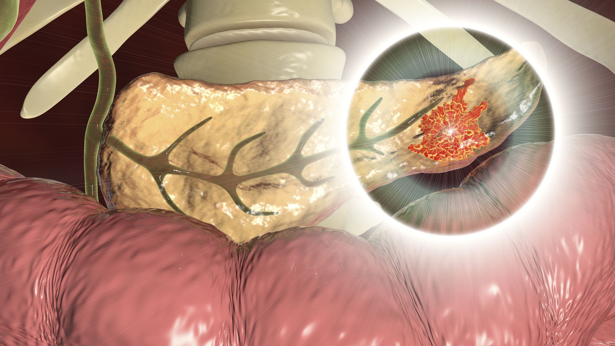 🔬 A possible treatment for deadly pancreatic cancer found