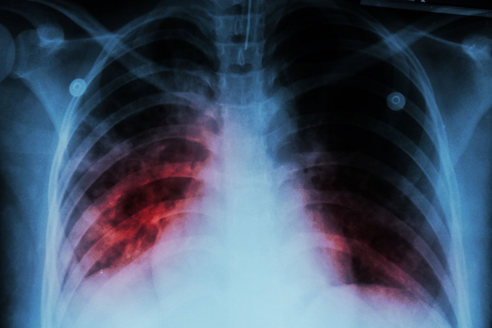 💉 First tuberculosis vaccine in 100 years is in sight