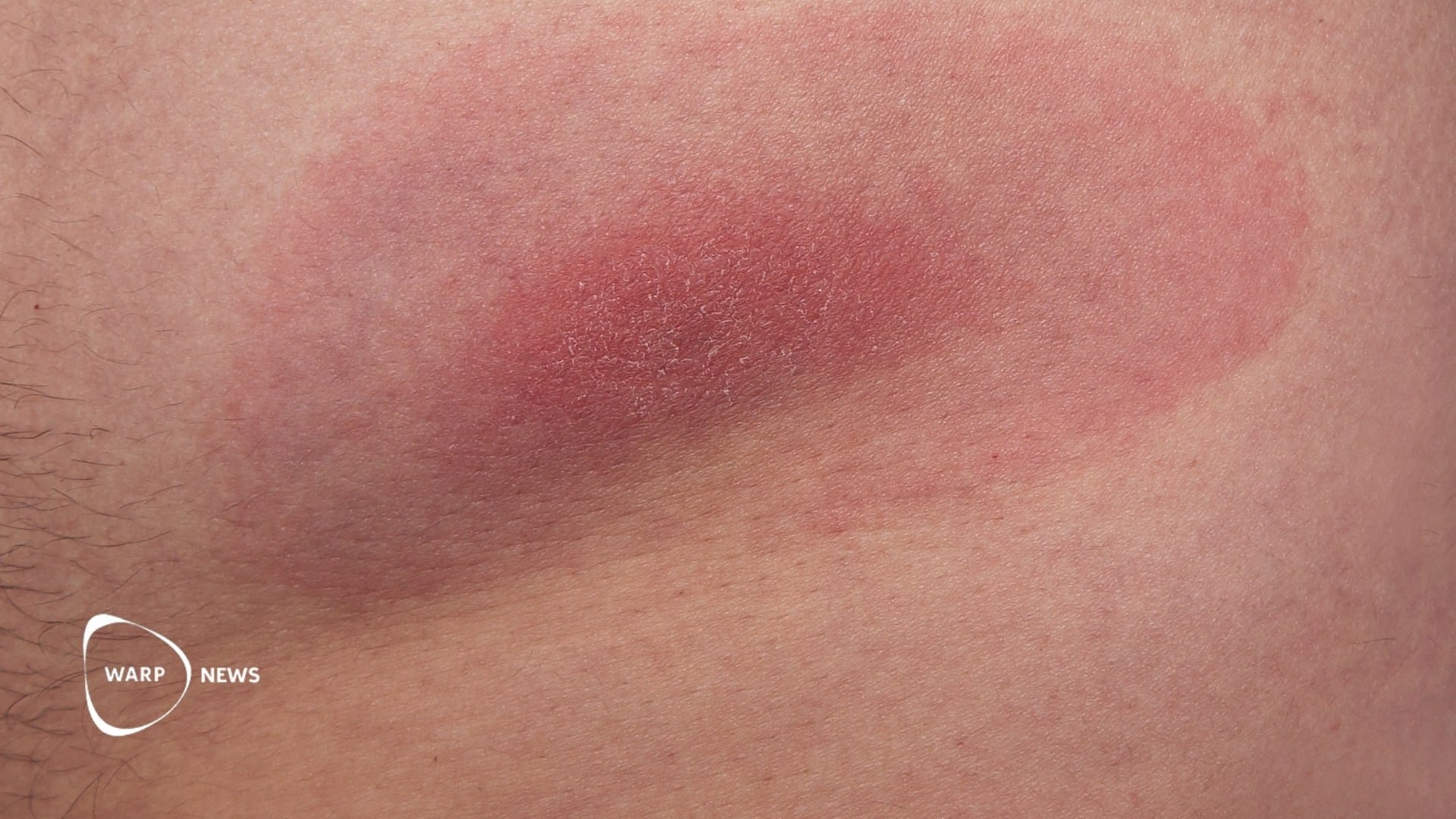 💉 New vaccine reduced Lyme disease cases by 70 percent in clinical trial