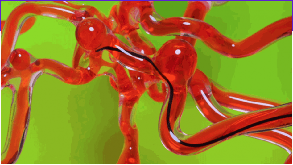 Revolutionary medical device worms its way into the field of stroke treatment