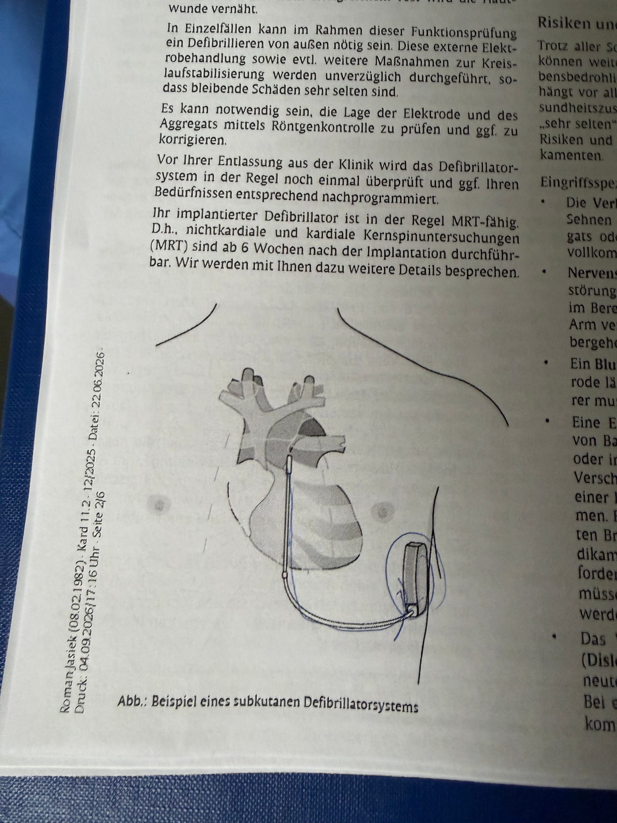 Eine medizinische Grafik zur Veranschaulichung eines subkutanen Defibrillatorsystems (S-ICD) mit implantiertem Aggregat an der linken Flanke und einer Elektrode direkt unter der Haut entlang des Brustbeins. © Knappschaft Kliniken Bottrop