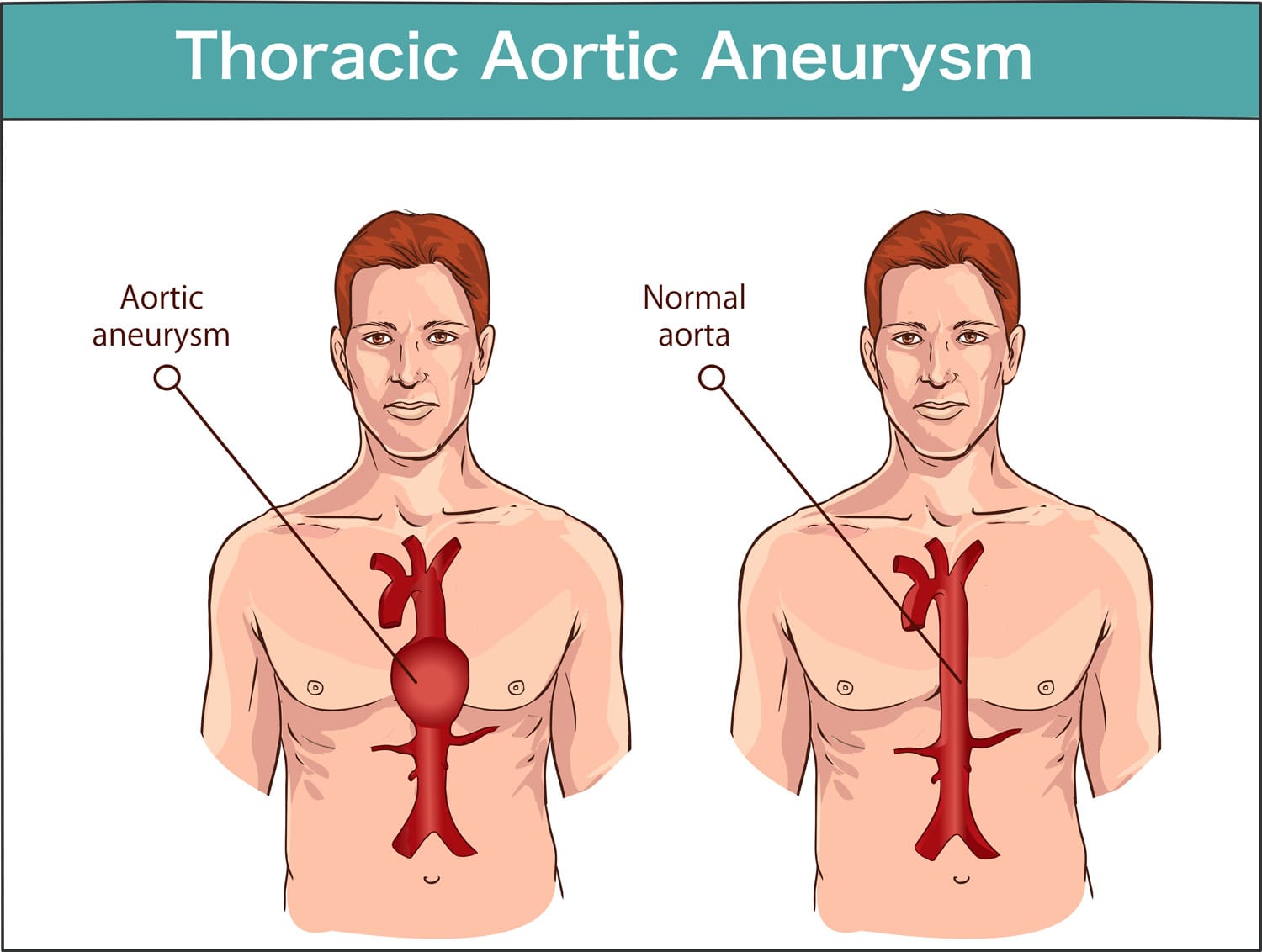 Medical diagram of a thoracic aortic aneurysm