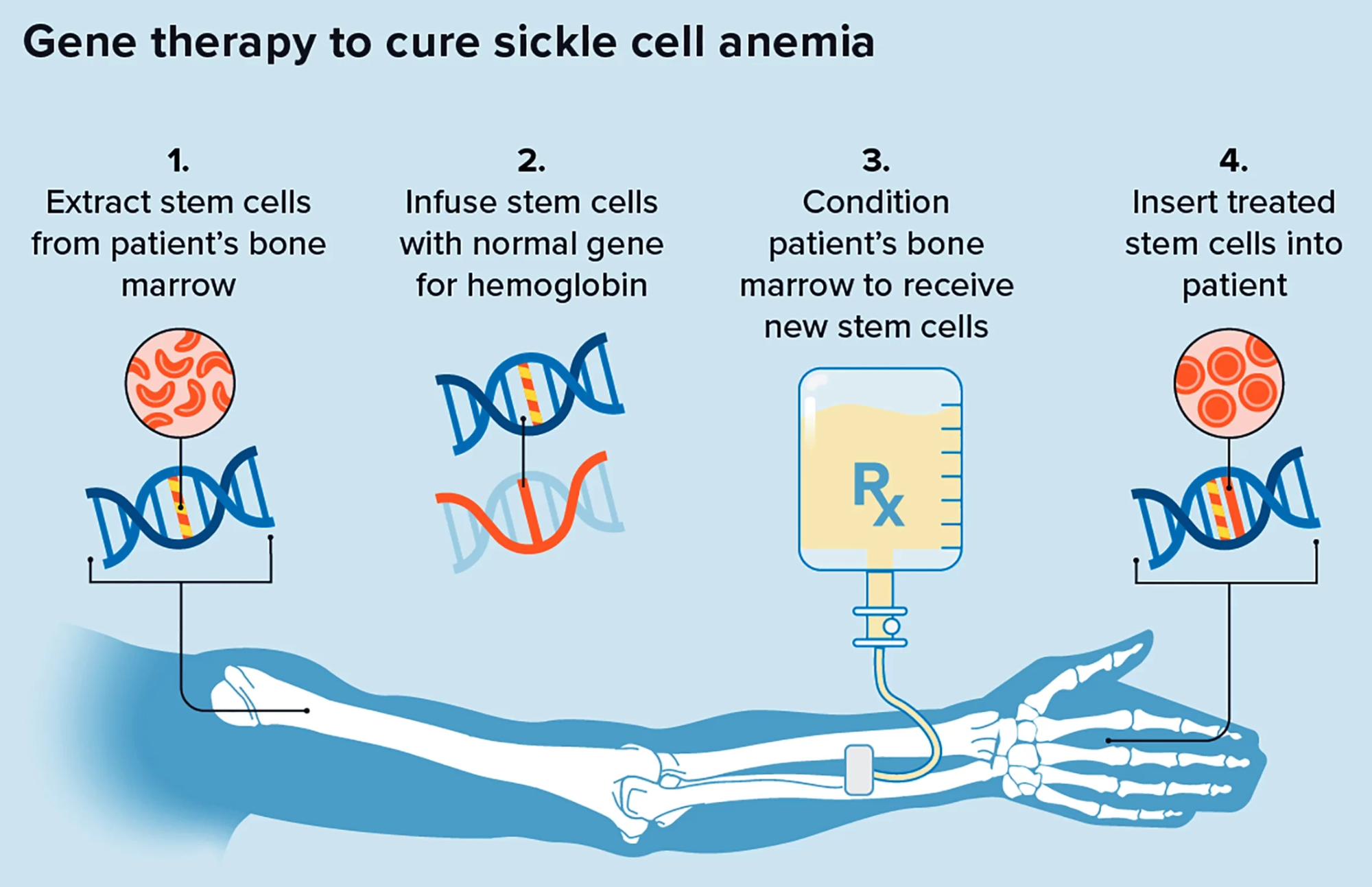 Gene editing: Casgevy & Lyf Genia | UPSC