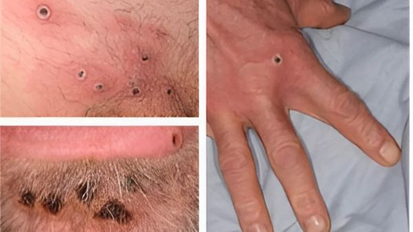 HSE Confirms Single Case Of Clade I Mpox in Ireland