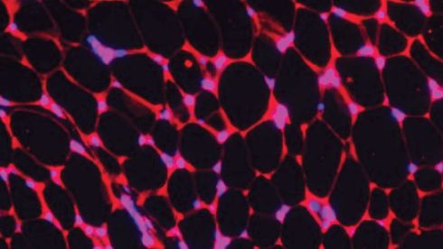 Bioengineered Fat Cells Show Promise in Cancer Treatment