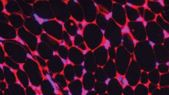 Bioengineered Fat Cells Show Promise in Cancer Treatment
