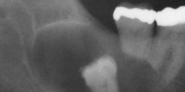 Whole Tooth: Wisdom Teeth Removal, Yes or No?