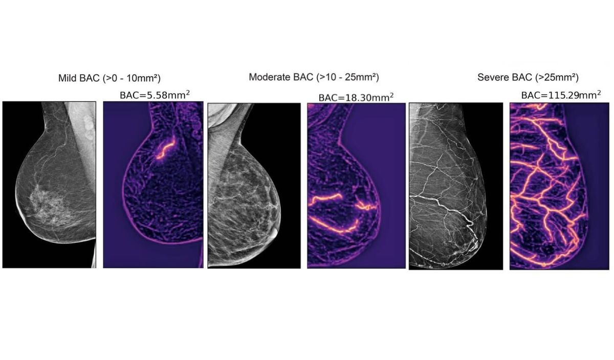 New AI Technology Uses Mammograms to Predict Cardiovascular Risk