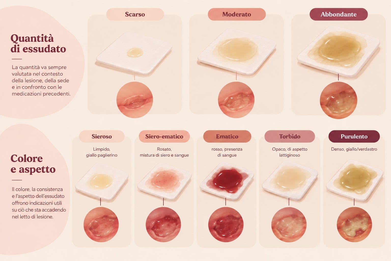 Infografica: quantità di essudato (scarso, moderato, abbondante) e cinque tipologie per colore e aspetto (sieroso, siero-ematico, ematico, torbido, purulento)