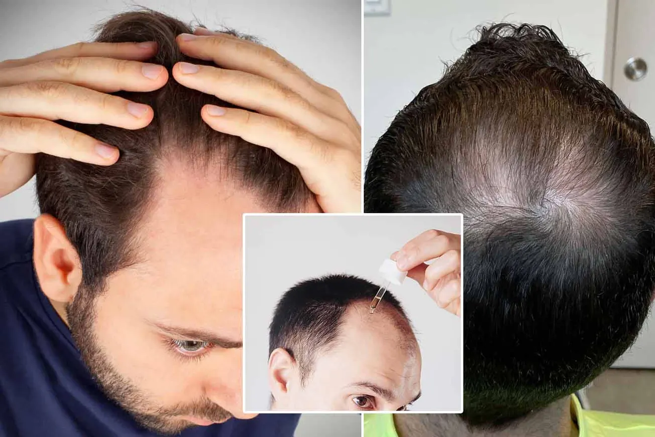 REVEALED: The Hair Loss "Miracle" No One's Talking About (Surgeons Don't Want You to Know This)