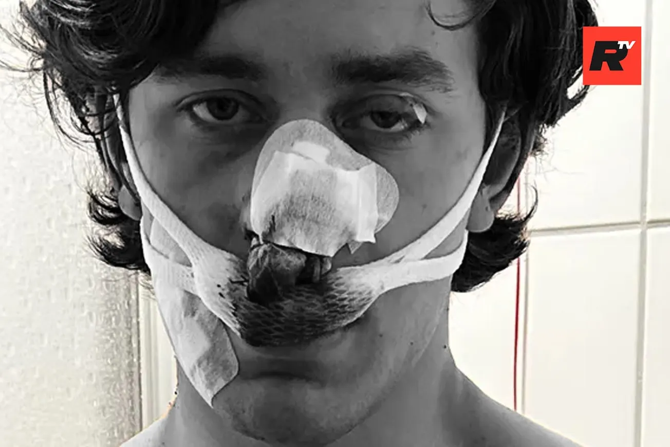 American Hero: U.S. Model Stabbed in the Face, Nearly Blinded By Illegal Aliens While Defending Women on German Tram, Syrian Suspect Rearrested After Initial Release