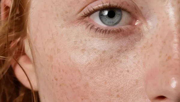 Why Is Irish Skin So Prone To Skin Conditions?