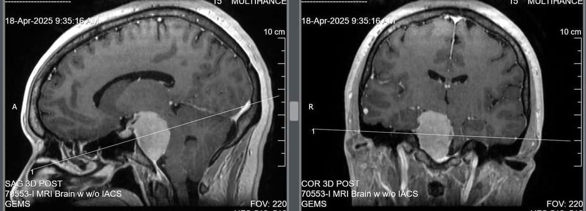 The big white spot in the middle of my head is the location of the meningioma. 