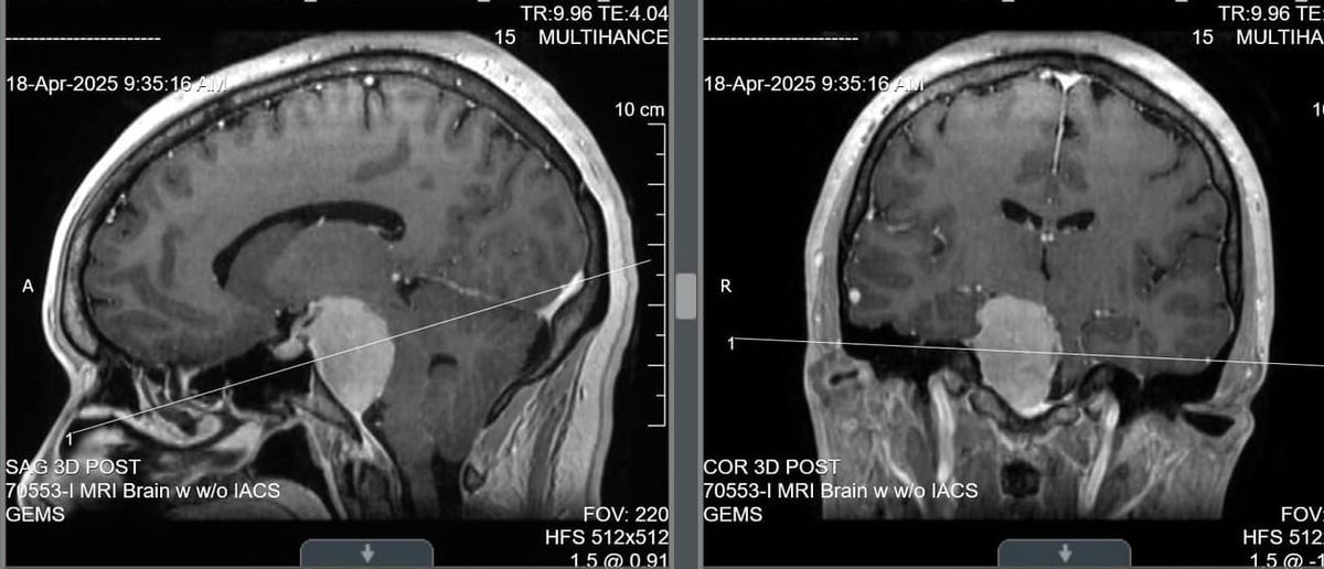 Welcome to My Mind... and My Meningioma*
